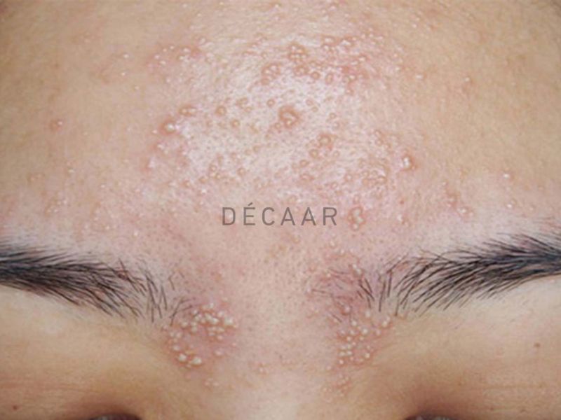 peel da lên mụn đầu trắng